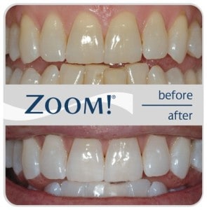 zoom teeth whitening safe kids