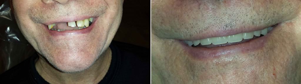 before-after-dentures-santa-rosa-dentist