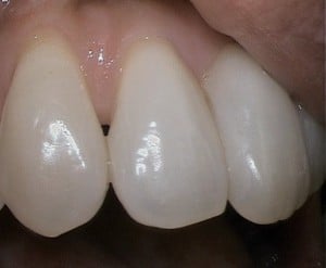 dental-cosmetic-bonding-after