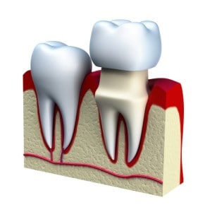 Dental crowns - Cosmetic Dentistry, Santa Rosa