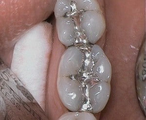 silver-tooth-fillings