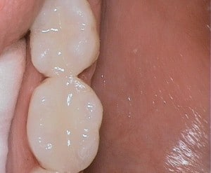 tooth-colored-fillings