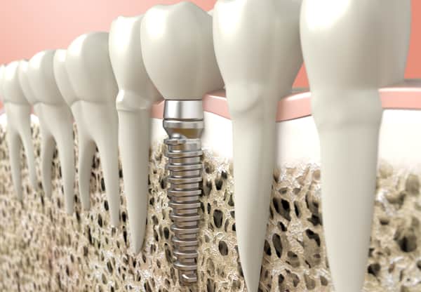 Dental Implants - Mark S. Frey, DDS