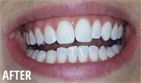 After Whitening