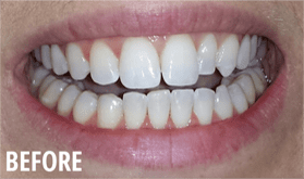 Before Whitening