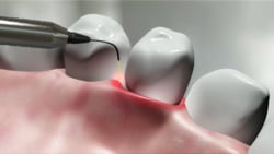 Best Dental Laser Therapy