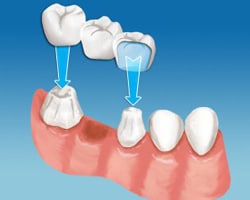 Safe Dental Bridge