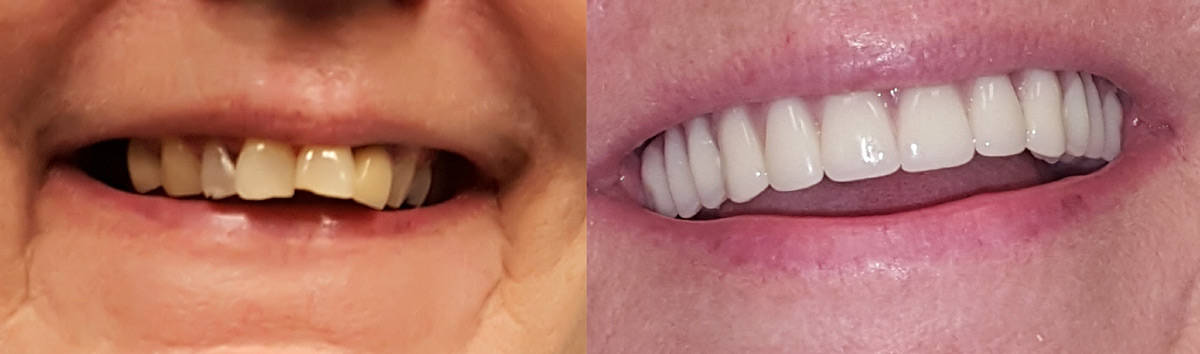 Teeth in a day, Before & After, Mark S. Frey, DDS - Santa Rosa cosmetic dentist
